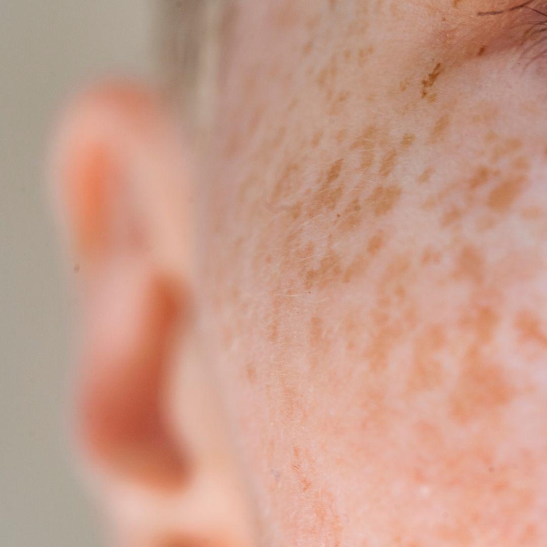 Tattooed freckles - the beauty trend of 2022